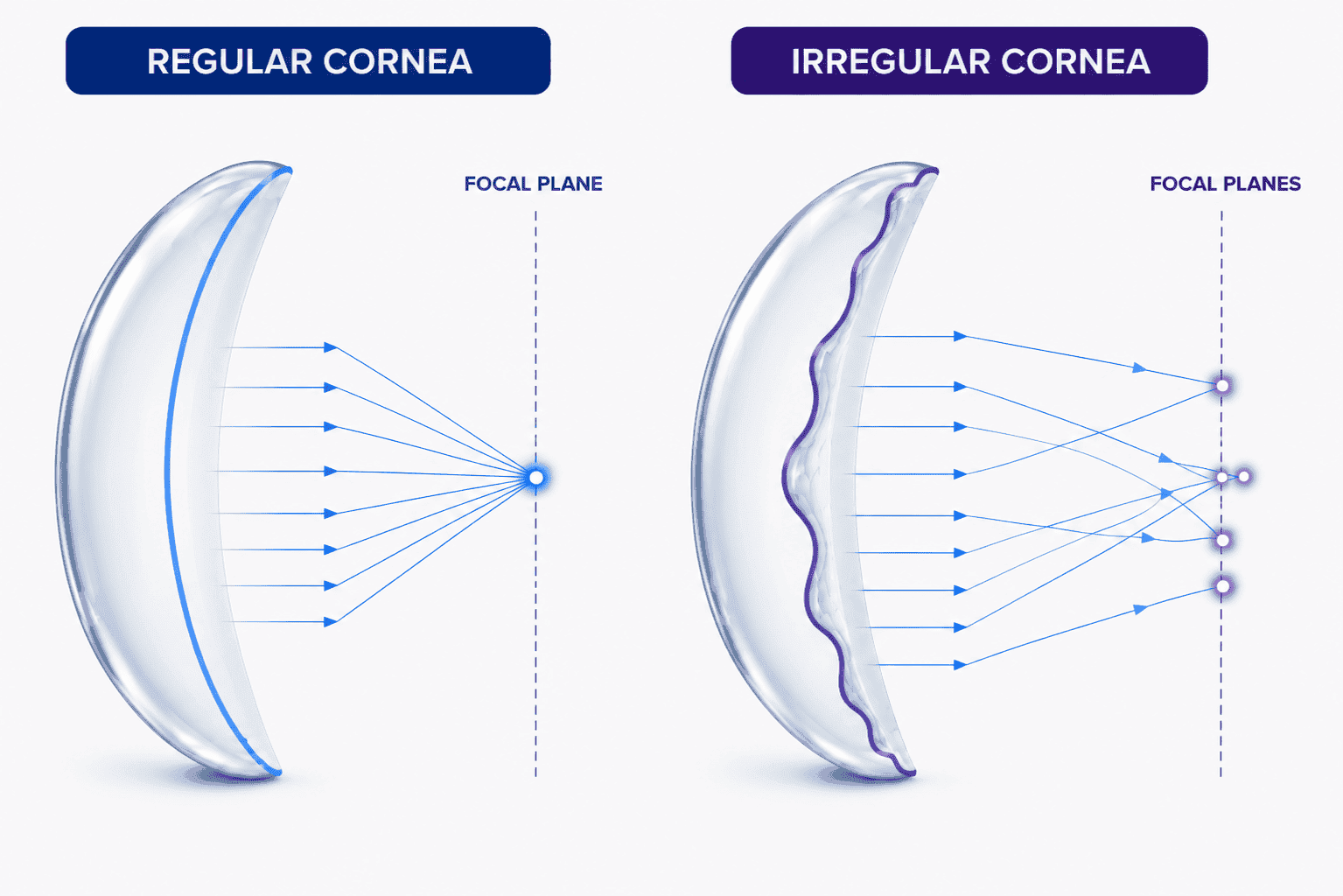 Irregular cornea