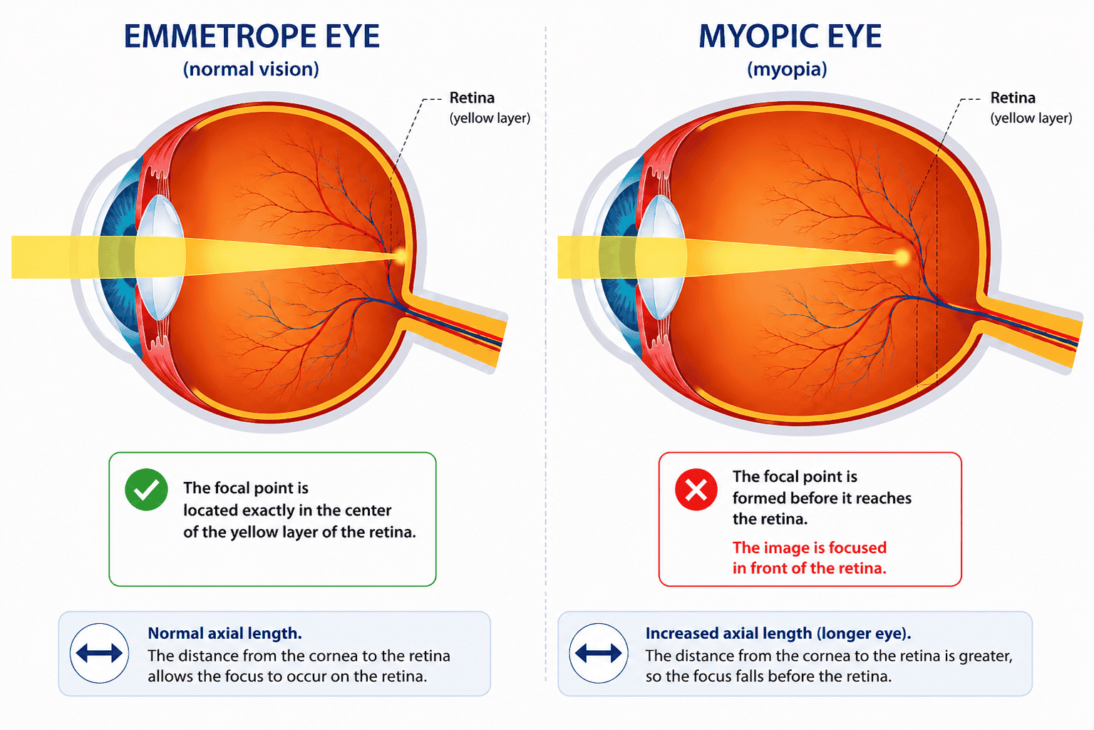 Myopic eye