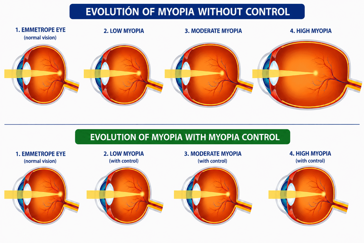 Myopia control