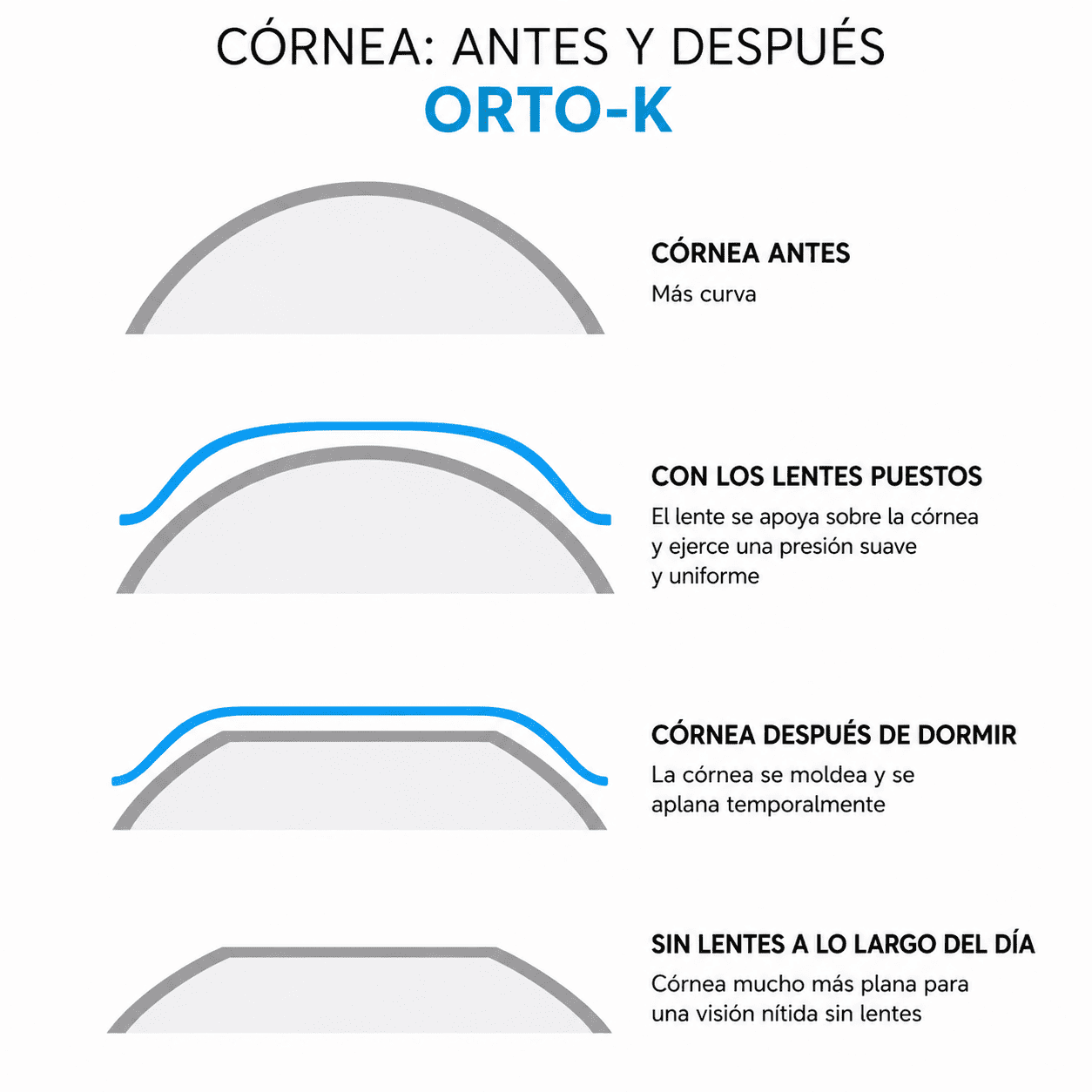Ortoqueratología